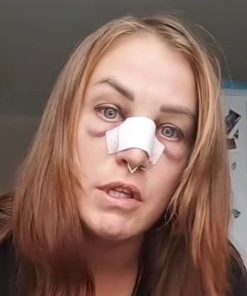 В метро Москвы мужчина попросил у женщины денег и сломал ей нос