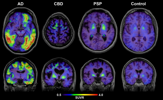 Результаты Amyloid PET (слева направо): пациент с болезнью Альцгеймера (AD), пациент с кортикобазальной дегенерацией (CBD), пациент с прогрессивным супрануклеарным параличом (PSP) и когнитивно здоровый пожилой человек (Control)