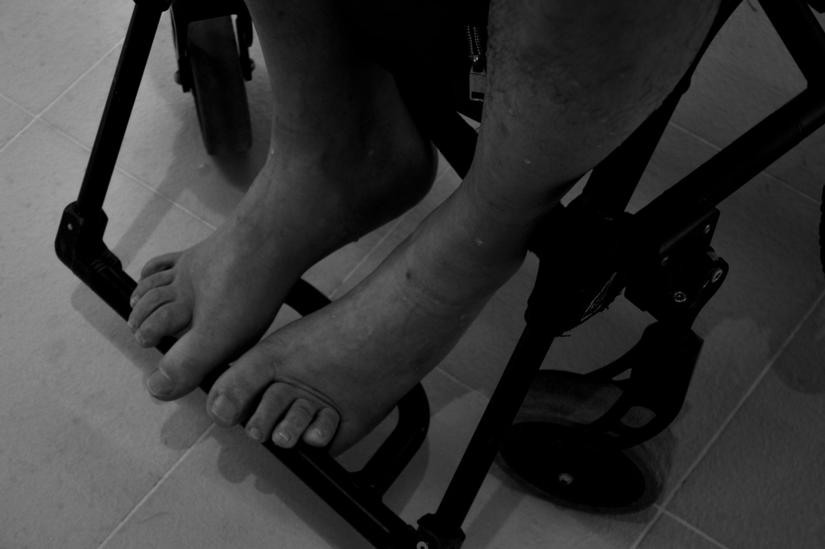 Ноги Андрея парализованы, он никогда не будет ходить