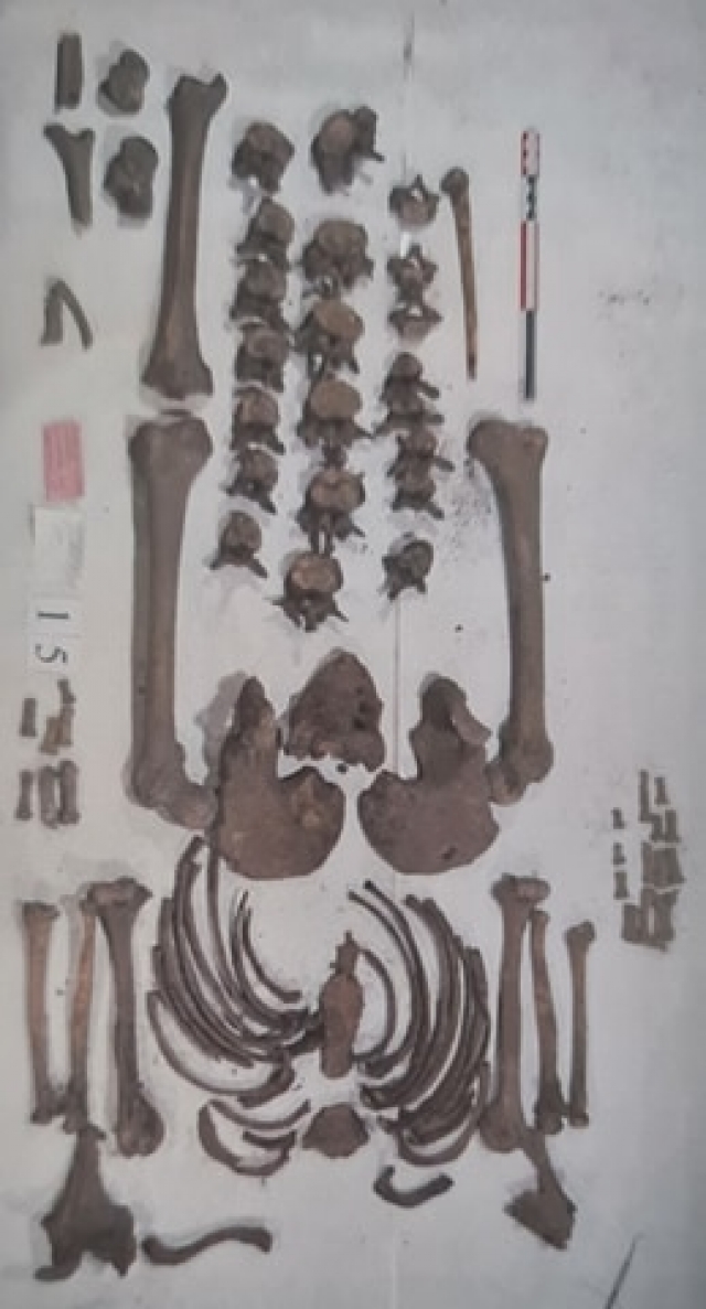 Скелет мужчины, перенесшего тяжелую травму, вылеченного и дожившего до пожилого возраста в Антониево-Сийском монастыре. Фото из отчета об археологических исследованиях