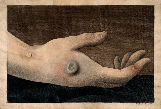 Человеческая рука с пустулами оспы